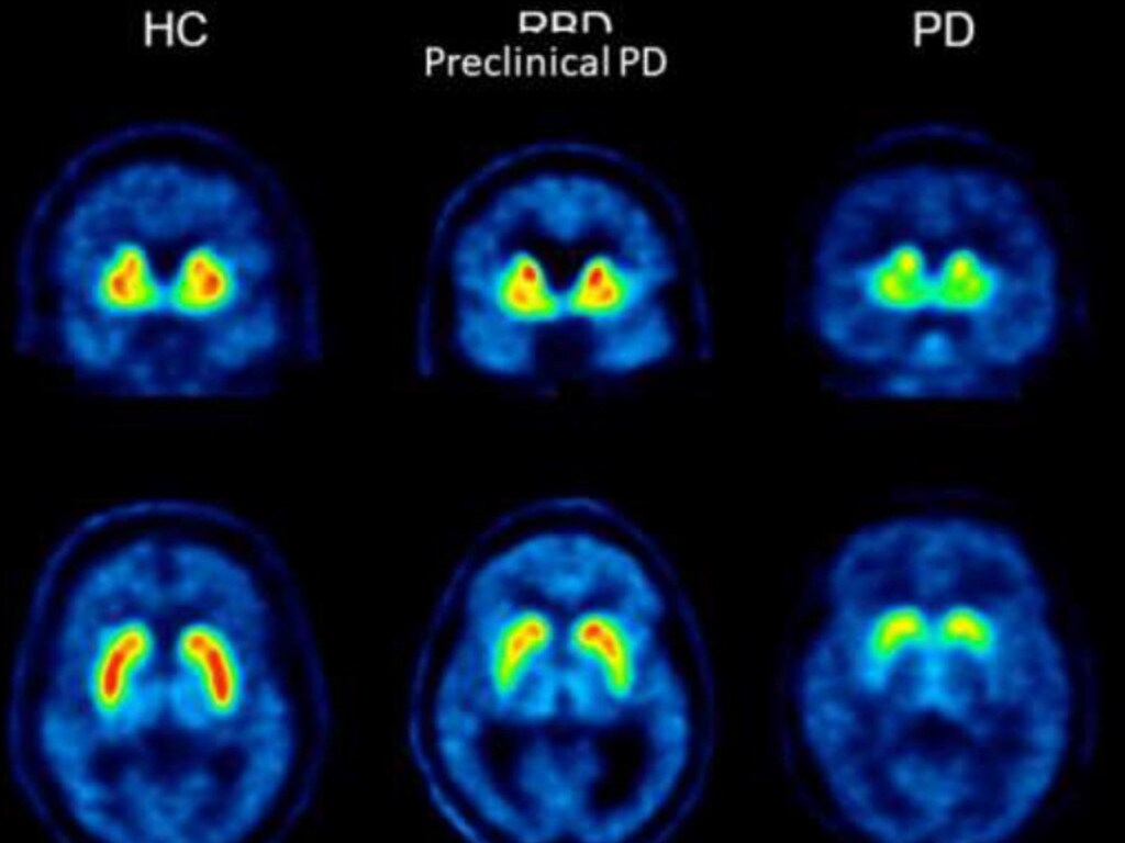 Coronavirus may increase risk of Parkinson’s disease, neurological
