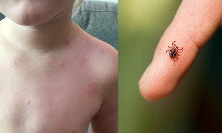 Tick bite warning Parents warned as the weather heats up Kidspot