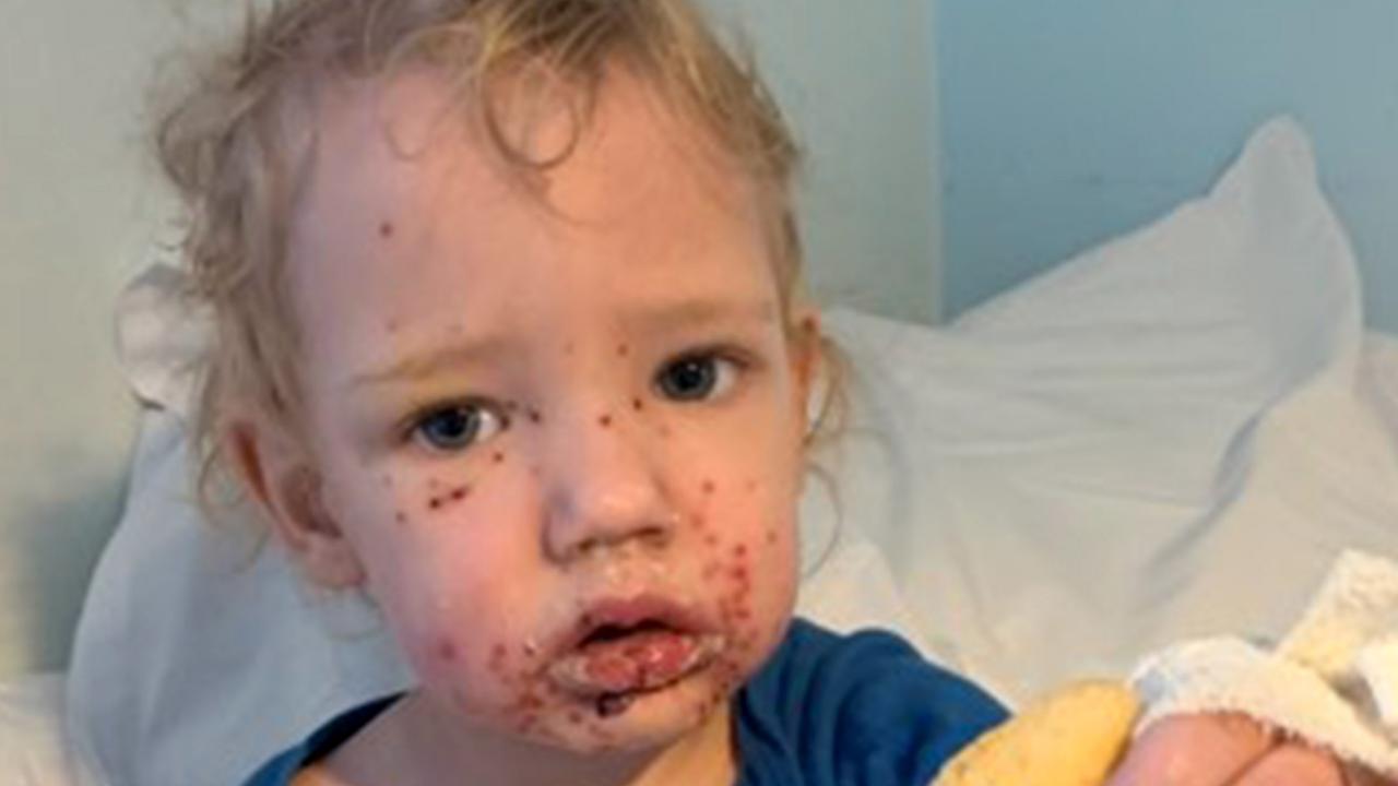 Toddler infected with herpes after suspected kiss Photo Gold Coast Bulletin