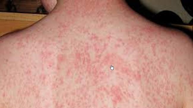 Brisbane measles baby Infected baby visited shopping centre, medical