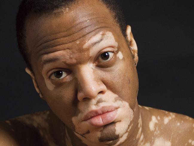 Blair Norfolk Australian model on how he cured his vitiligo