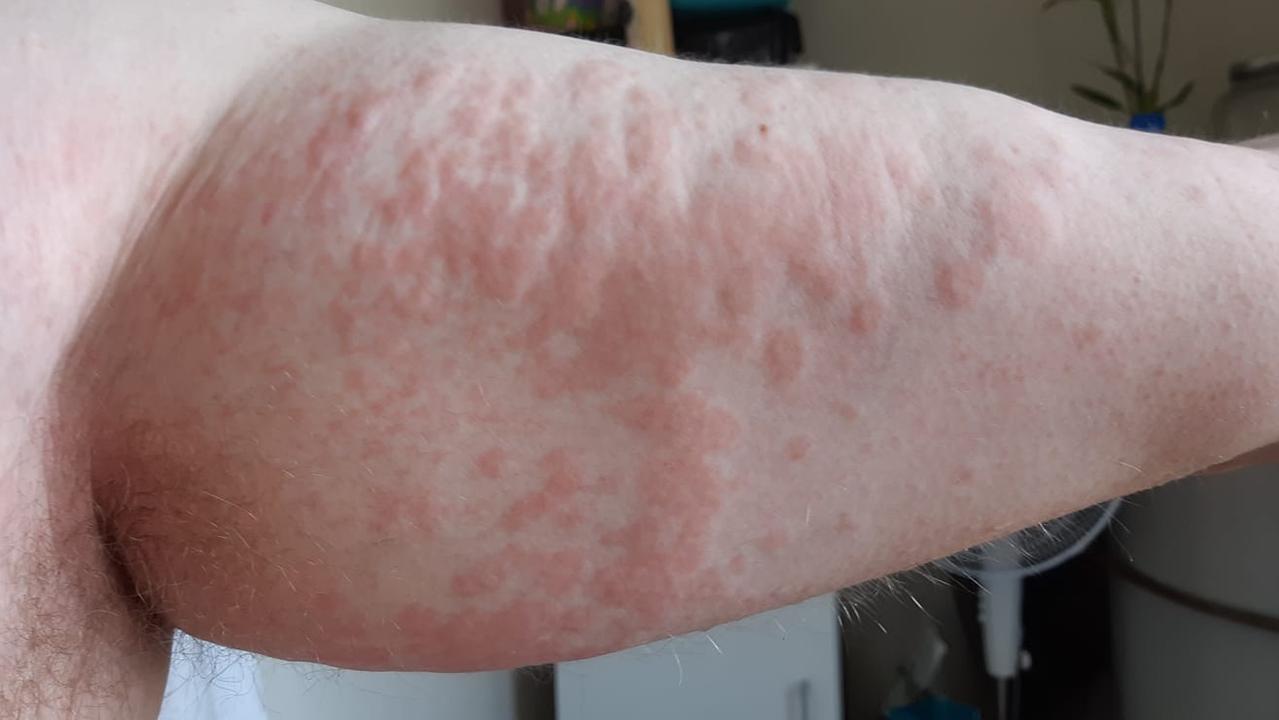 Lara rash residents developing ‘hivelike’ skin irritation Gold