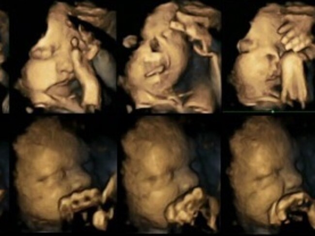 4D ultrasound study shows harmful effects of smoking on unborn babies