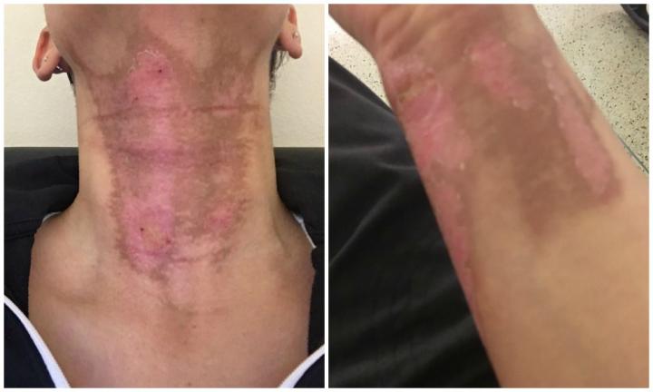Essential oils and UV rays can cause painful burns in some