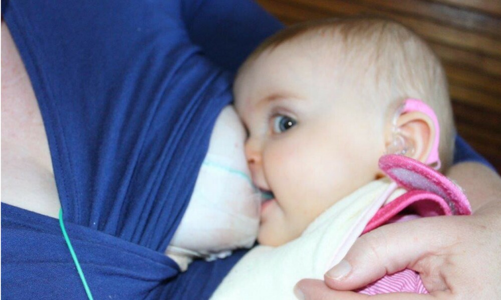 Breastfeeding a baby with a cleft palate 'Nothing was