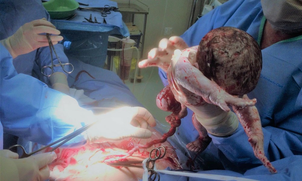 'My uterine fibroid was the size of my baby' Kidspot