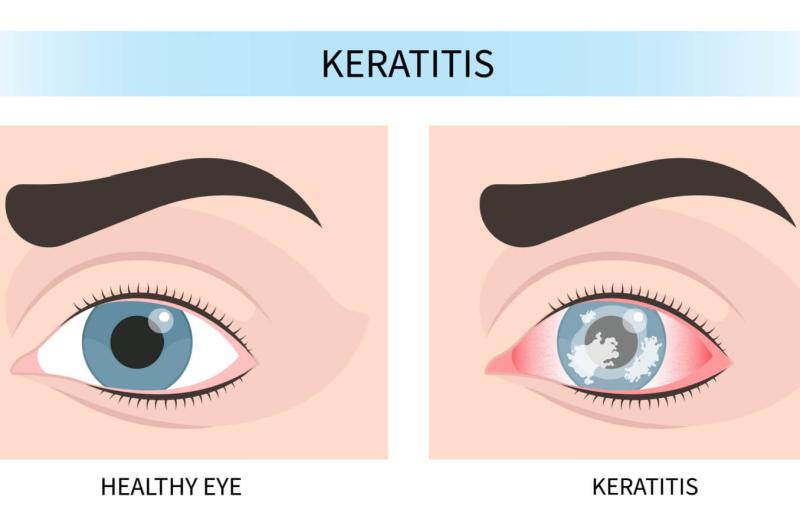 Fungal Keratitis Treatment Market Is Booming Worldwide with