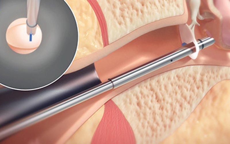 Tympanostomy Tube Systems Market Is Booming Worldwide Growth