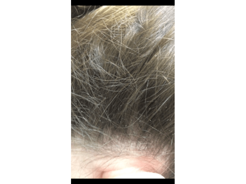 Lice Where Do They Come From? Millburn, NJ Patch