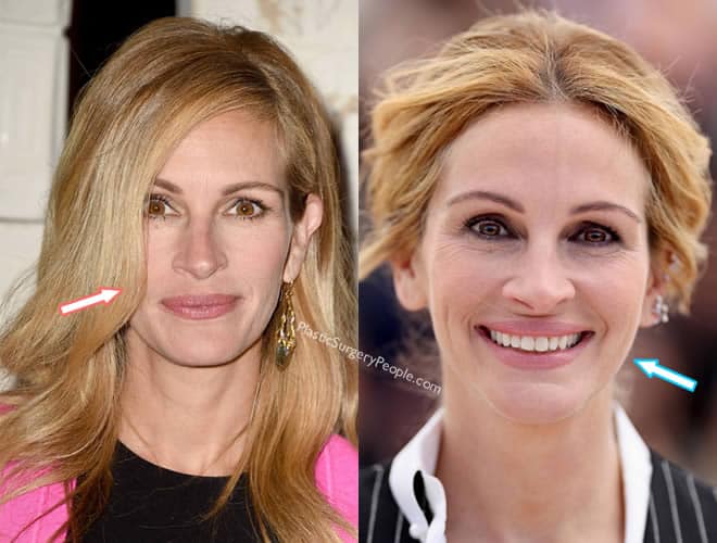 Julia Roberts Plastic Surgery Before And After Photos