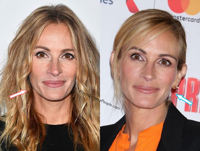 Julia Roberts Plastic Surgery Before And After Photos
