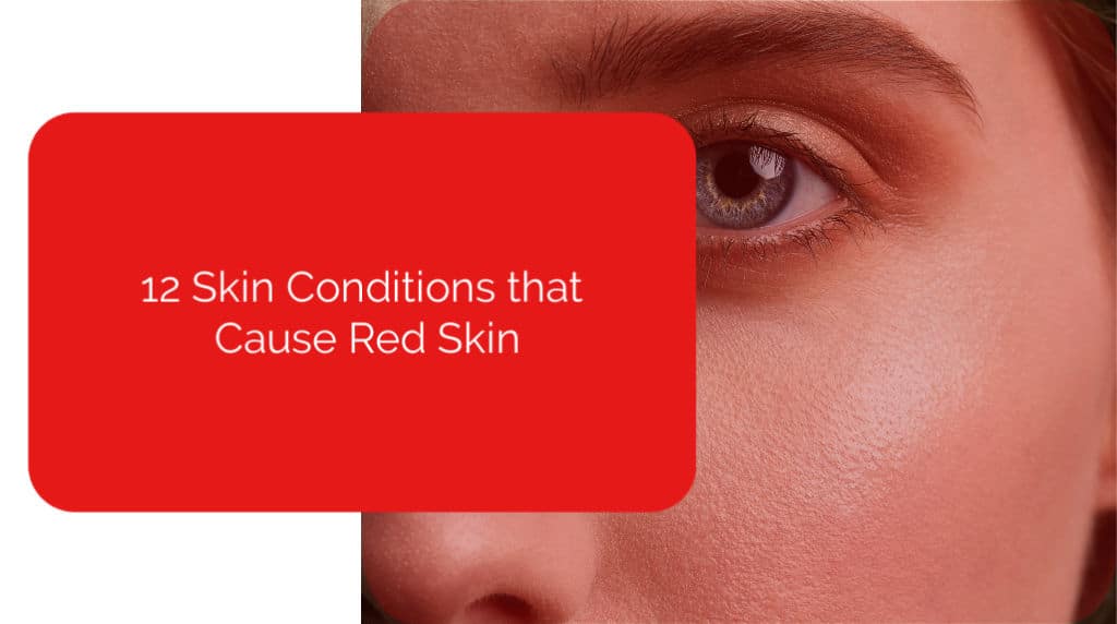 12 Skin Conditions That Cause Red Skin Power of Positivity