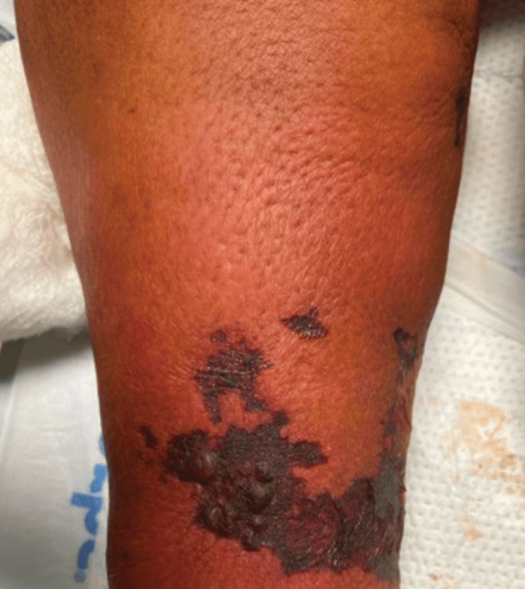WarfarinInduced Nonuremic Calciphylaxis A Case Study and Overview