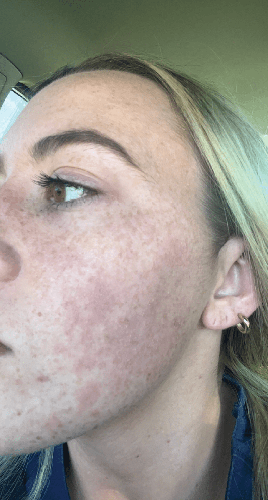 Acute Contact Urticaria Due To Use of Cocamidopropyl BetaineContaining