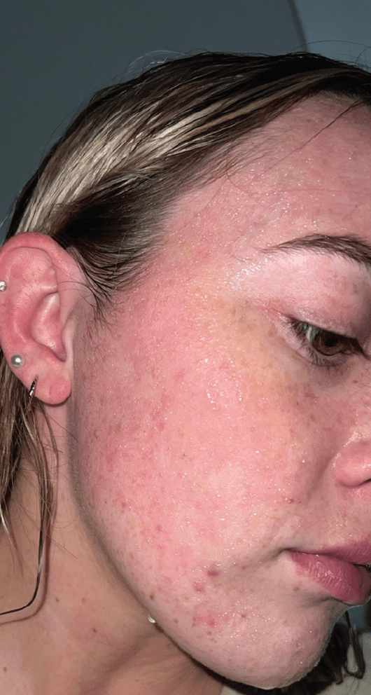 Acute Contact Urticaria Due To Use of Cocamidopropyl BetaineContaining