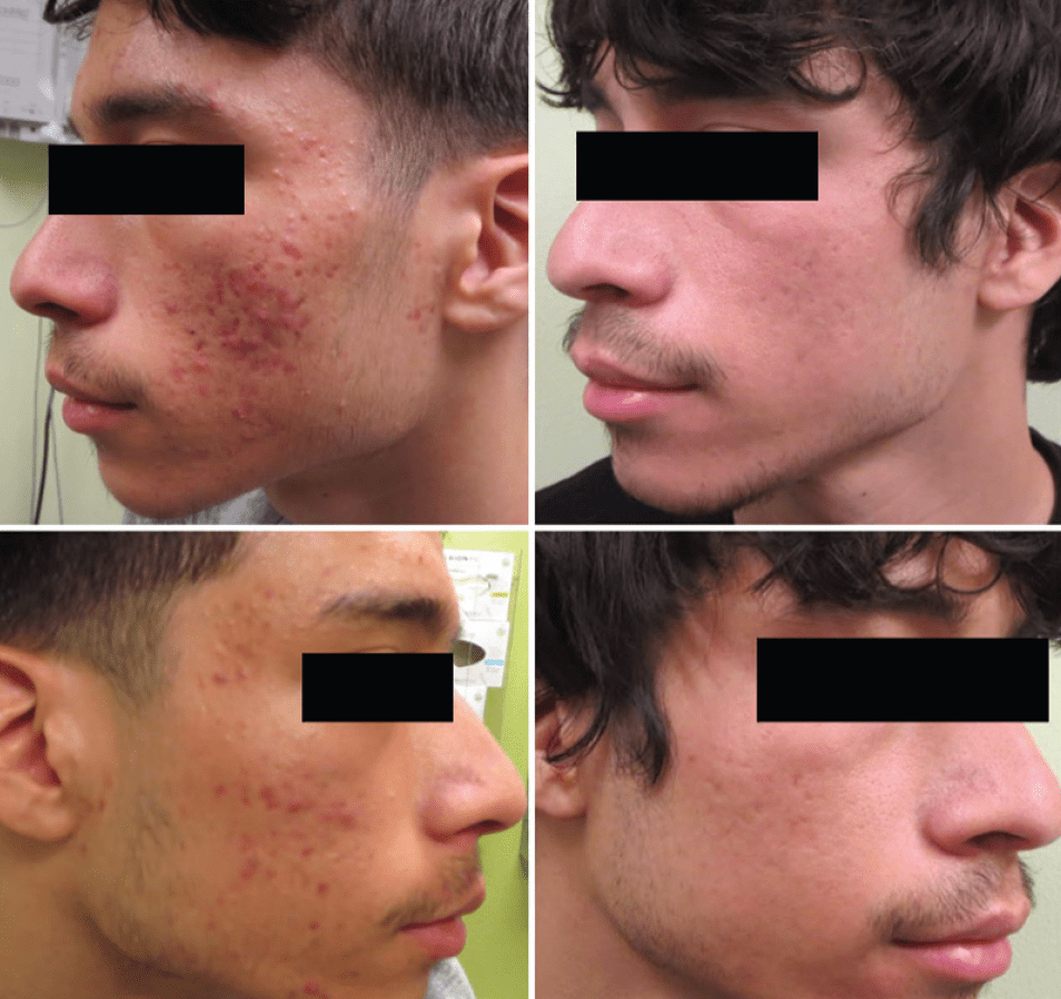 Laser Therapy for Atrophic Acne Scars A Case and Evidencebased Updates