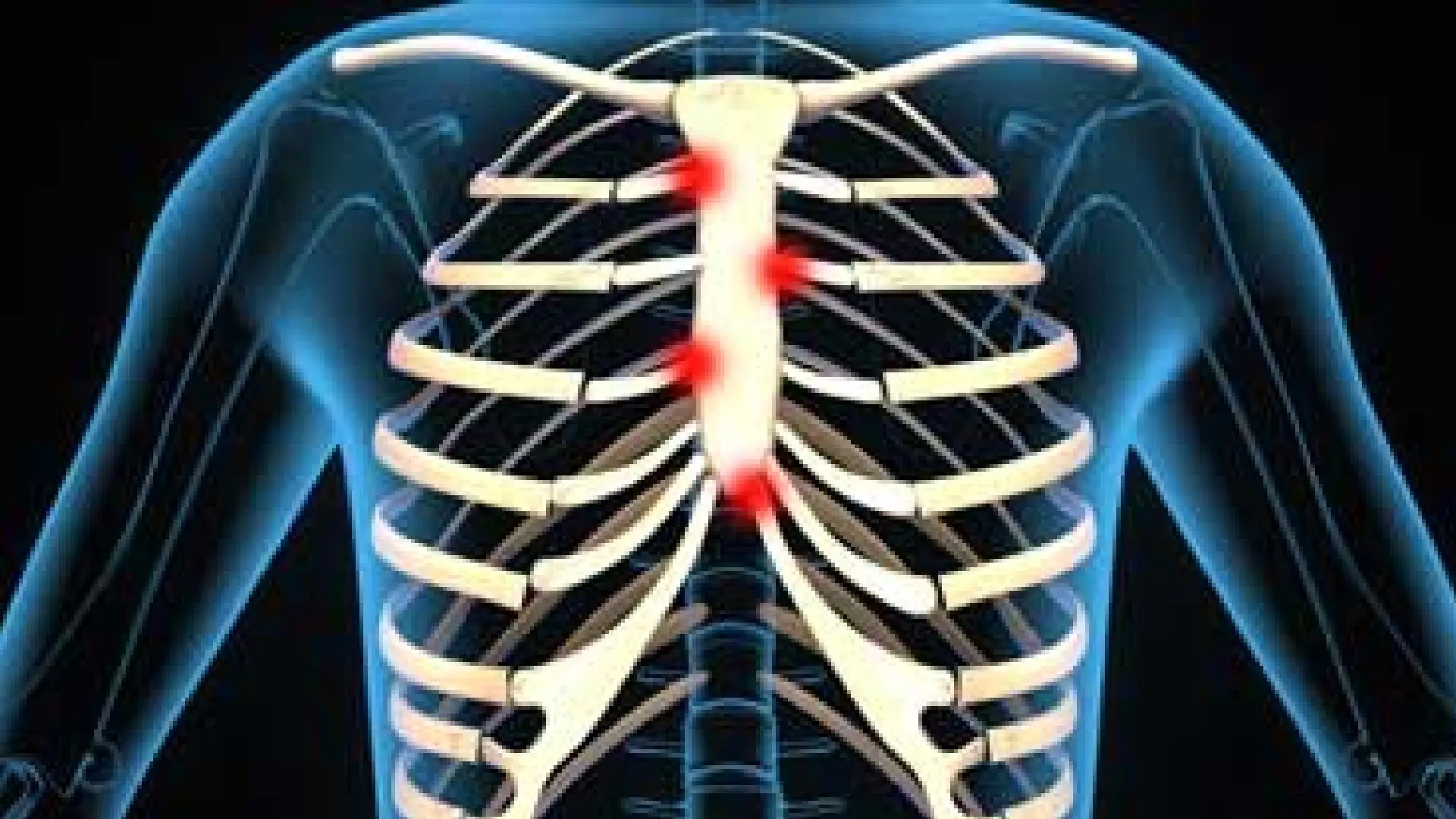 Understanding Costochondritis Symptoms, Diagnosis, and Treatment PUNE.NEWS