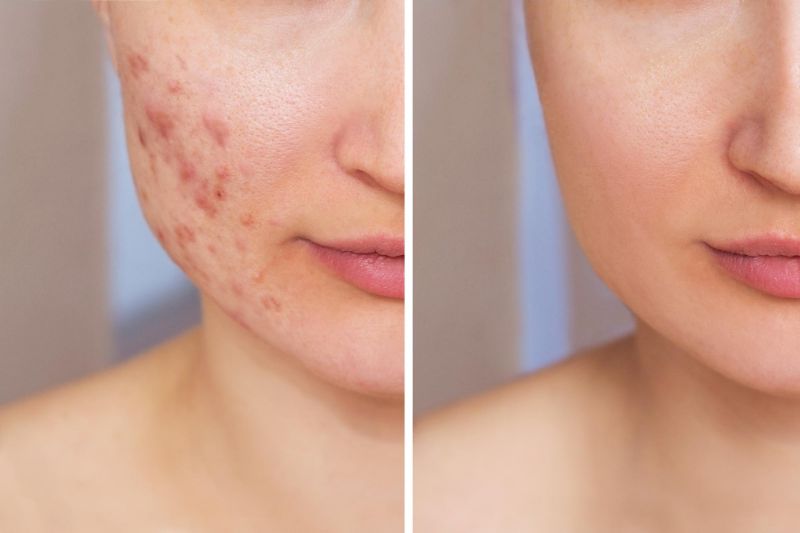 Can Retinol Cause Acne? RemoteDerm