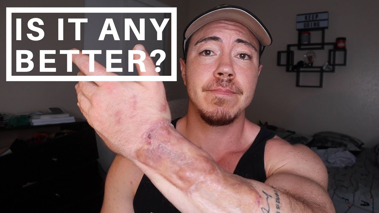 Ftm top surgery los angeles sorexpress