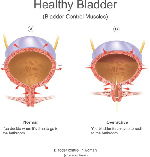 What Causes Bladder Leakage? Types & Causes of Urinary Incontinence Proof
