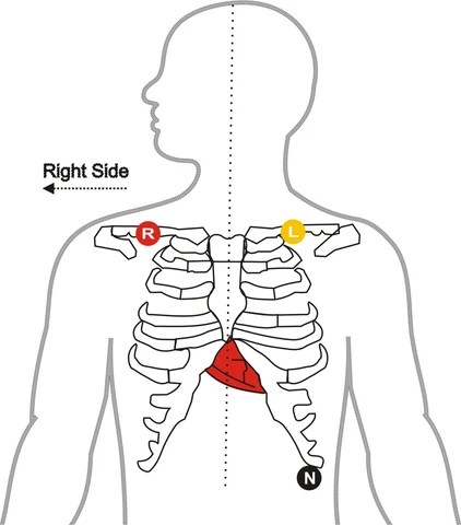 Ekg Lead Placement 3 Lead ECG Nursing Unraveled