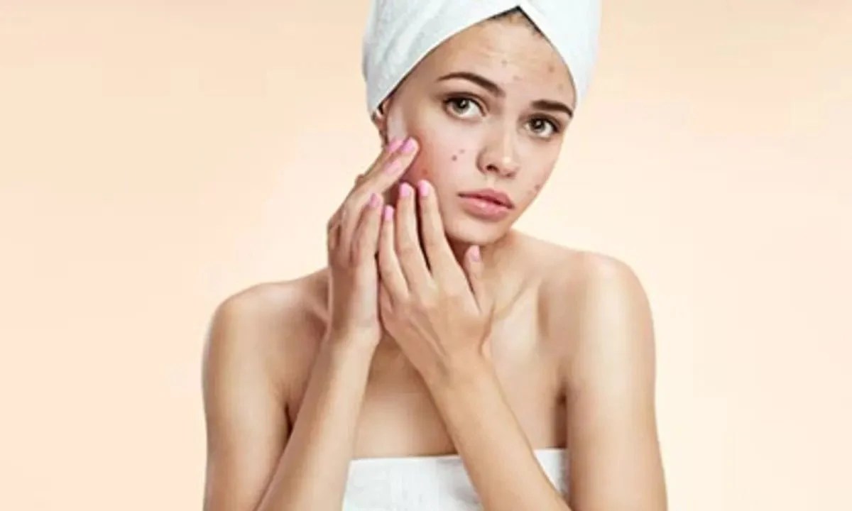 How to avoid pimples? Simple habits can help you