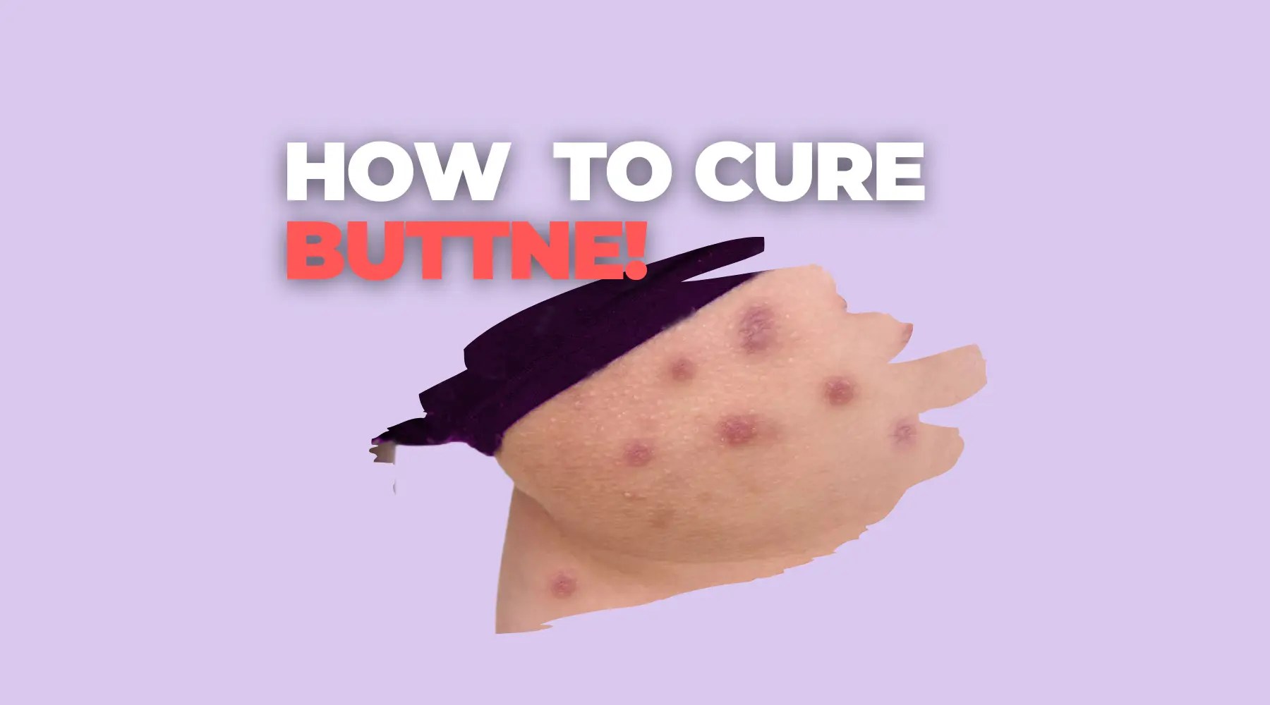How To Treat Buttne/Butt Acne Aqneeq