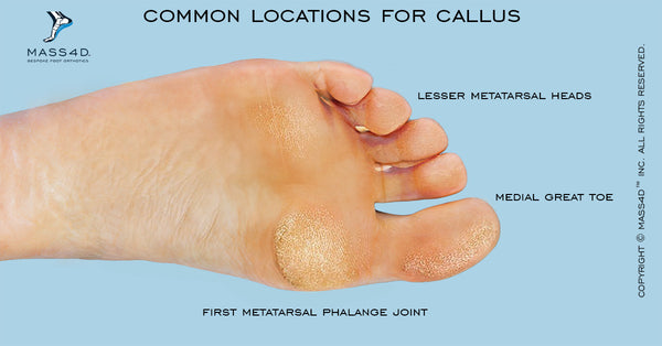 Diagnosis, Causes and Treatment of Callus MASS4D® Foot