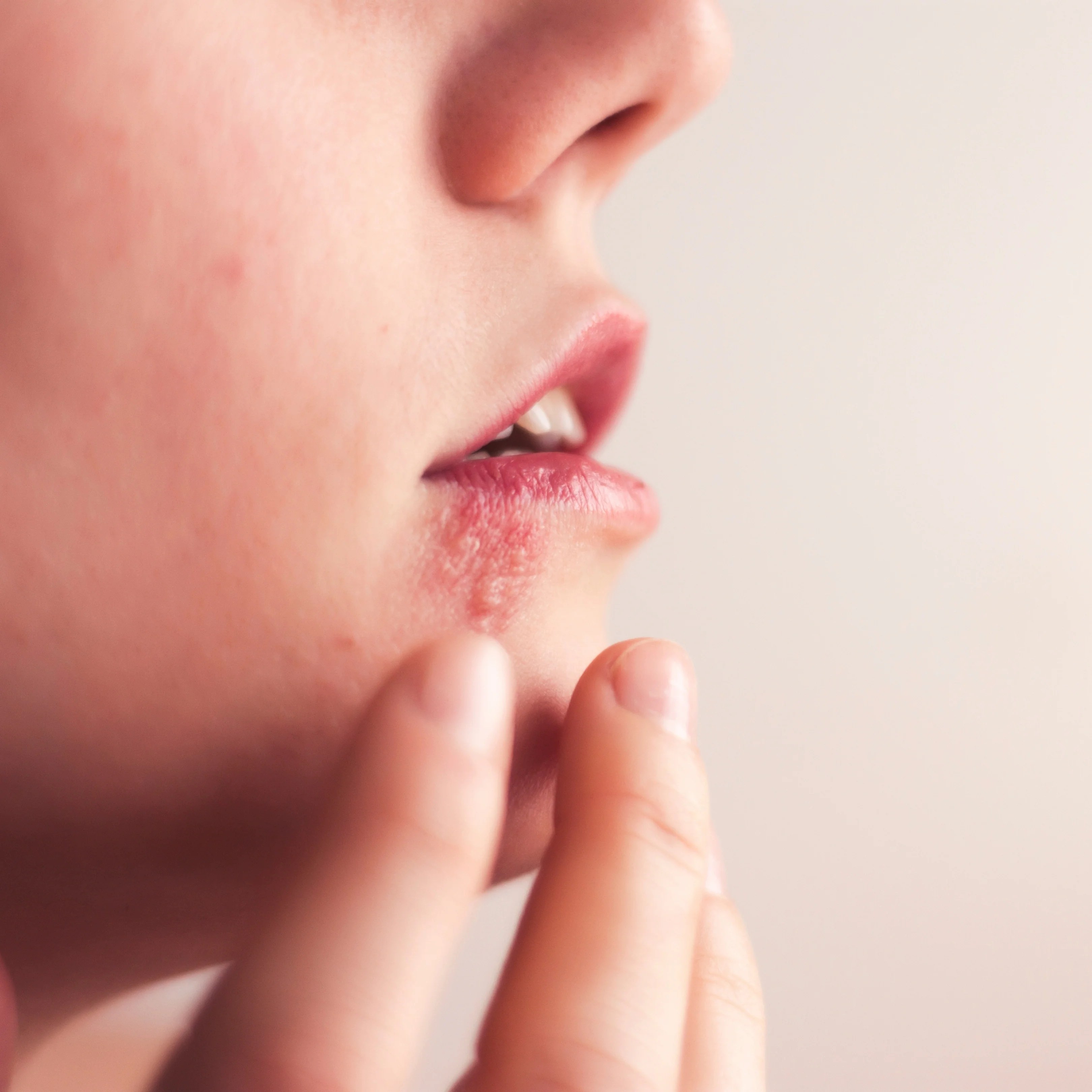 About Oral Herpes Oral Herpes Causes and Treatments Forces of