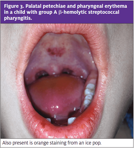 Pediatric Oral Lesions in the Urgent Care Setting Journal of Urgent Care Medicine