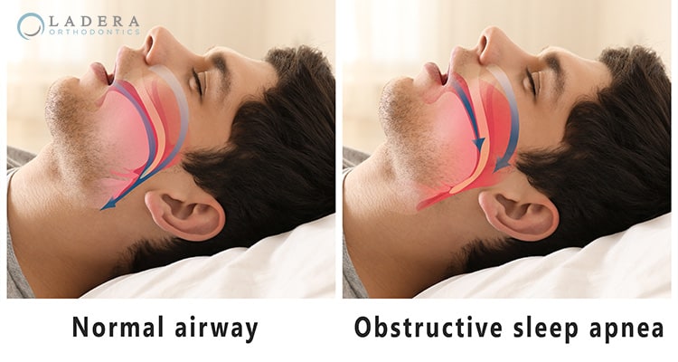 Get Relief From Sleep Apnea from Your Ladera Ranch Orthodontist