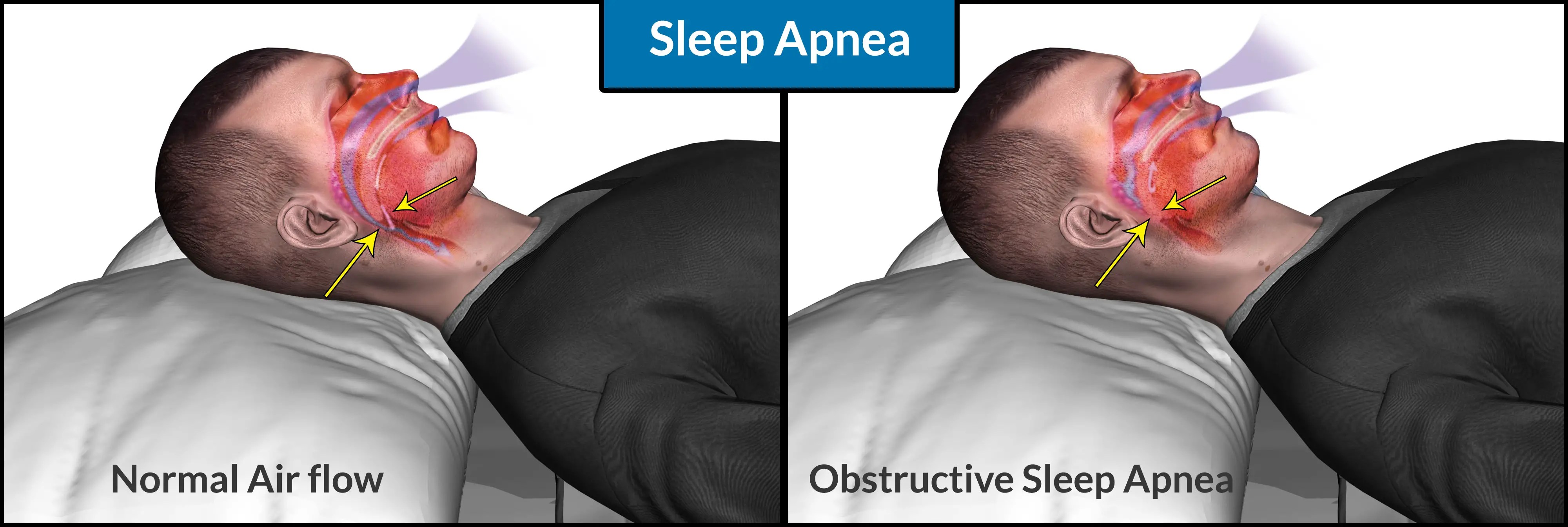 Unlocking the Puzzle Understanding How Obstructive Sleep Apnea Fits in