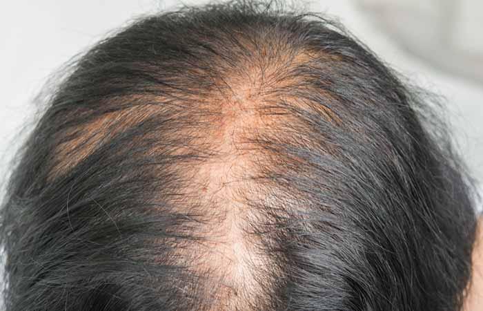 Androgenic Alopecia Causes, Treatment, And More