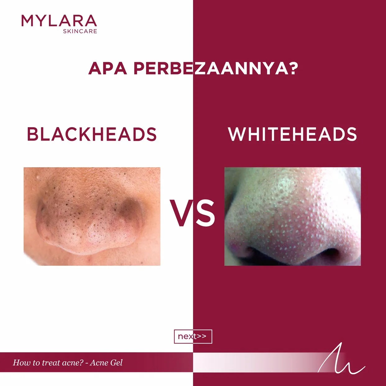BLACKHEAD VS WHITEHEAD MYLARA Skincare