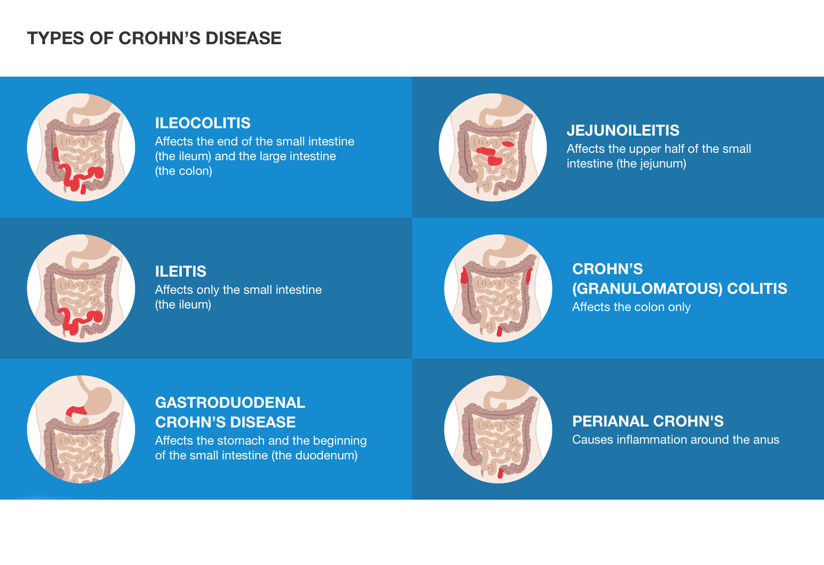 What Is Crohn’s Disease? StoryMD
