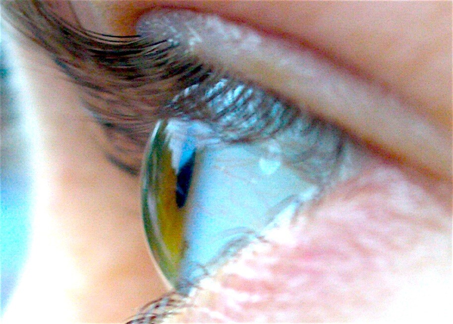 The Risks of Tanning Eye Damage Photokeratitis StoryMD