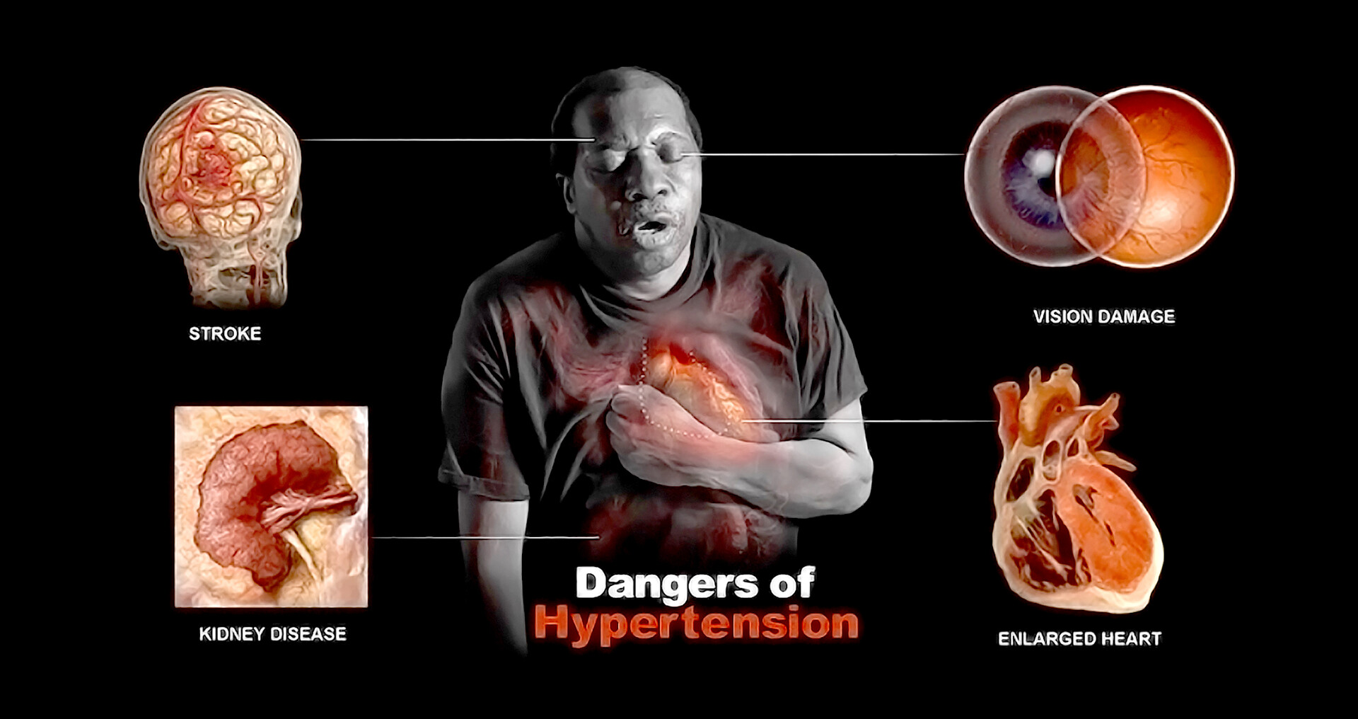 Cardiomegaly (Enlarged Heart) Symptoms, Diagnosis,, 43 OFF