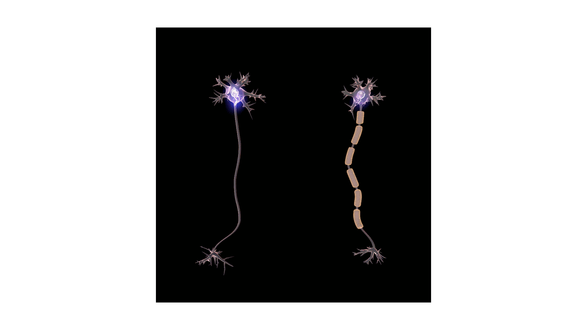 What Causes Trigeminal Neuralgia? StoryMD
