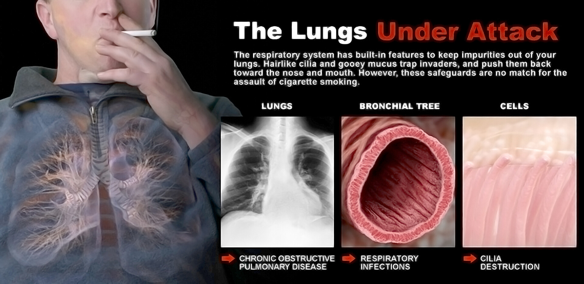 Smoking Is the Major Risk Factor for NonSmall Cell Lung Cancer StoryMD