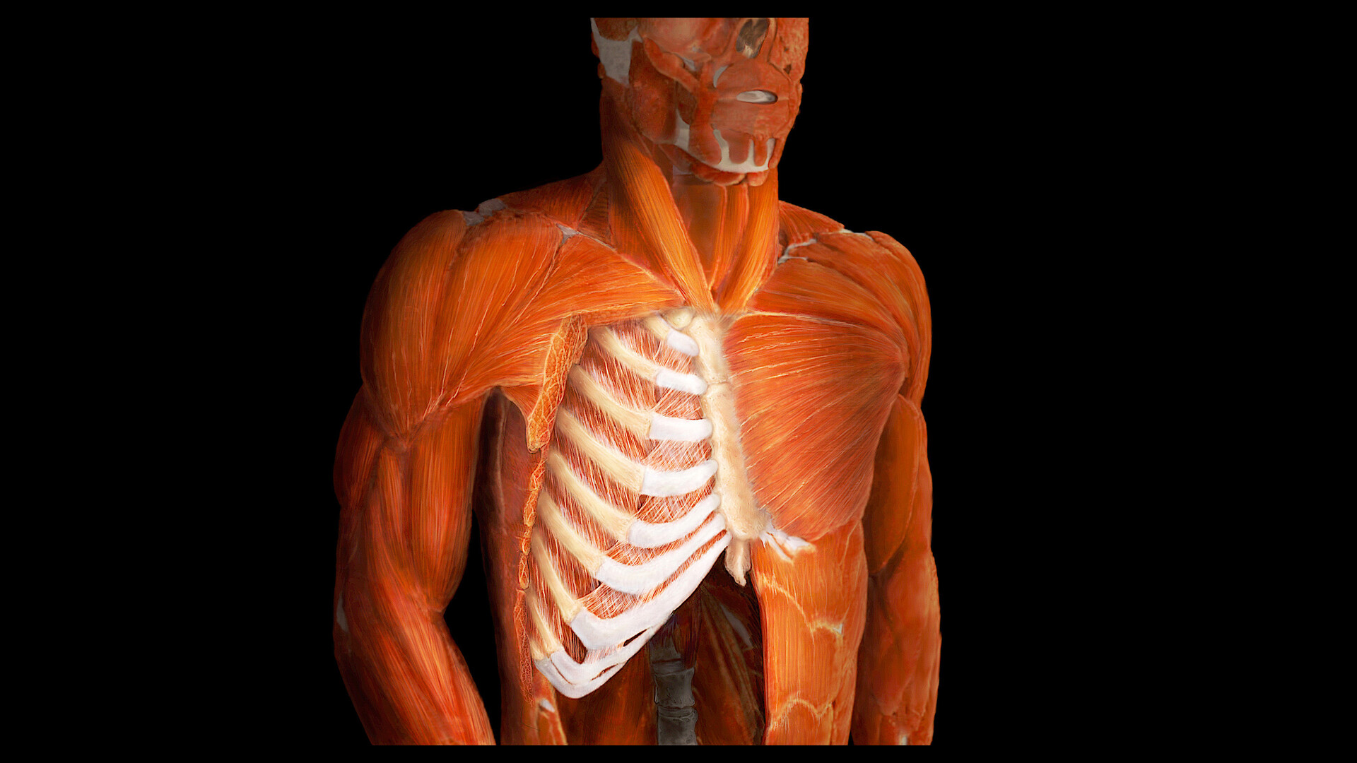 Costochondritis StoryMD