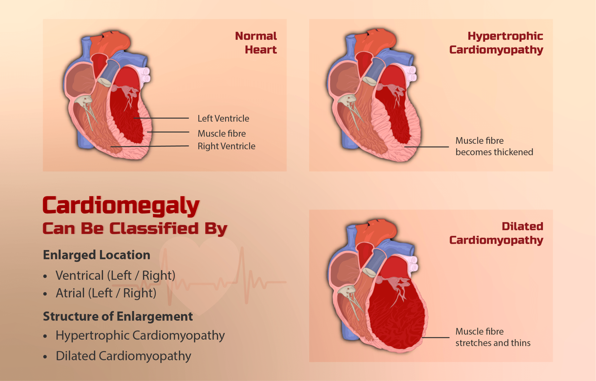What Is Familial Hypertrophic Cardiomyopathy? StoryMD