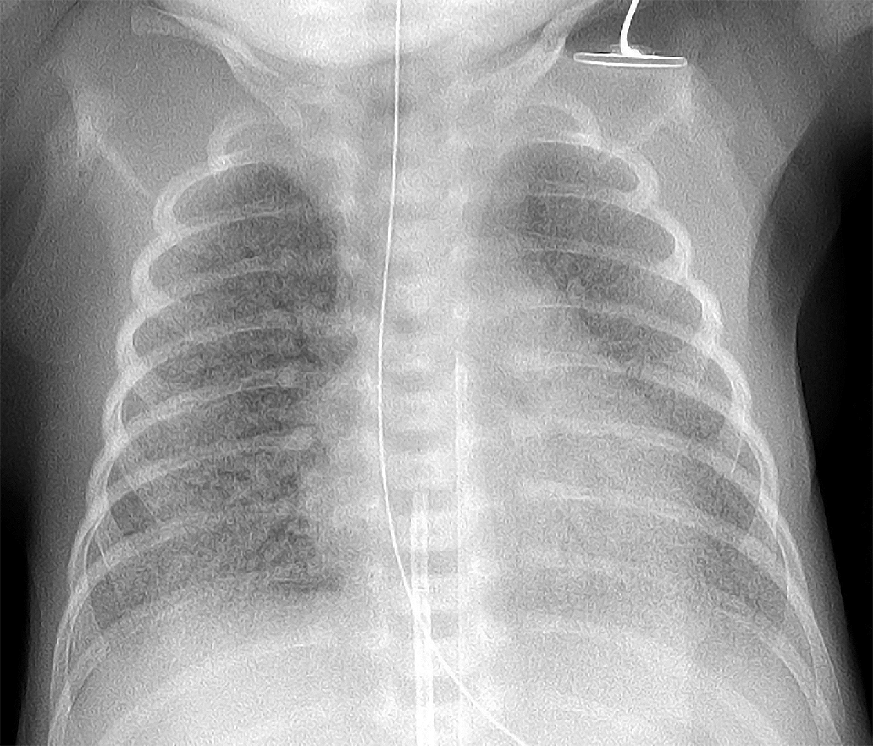 Respiratory Distress Syndrome X Ray
