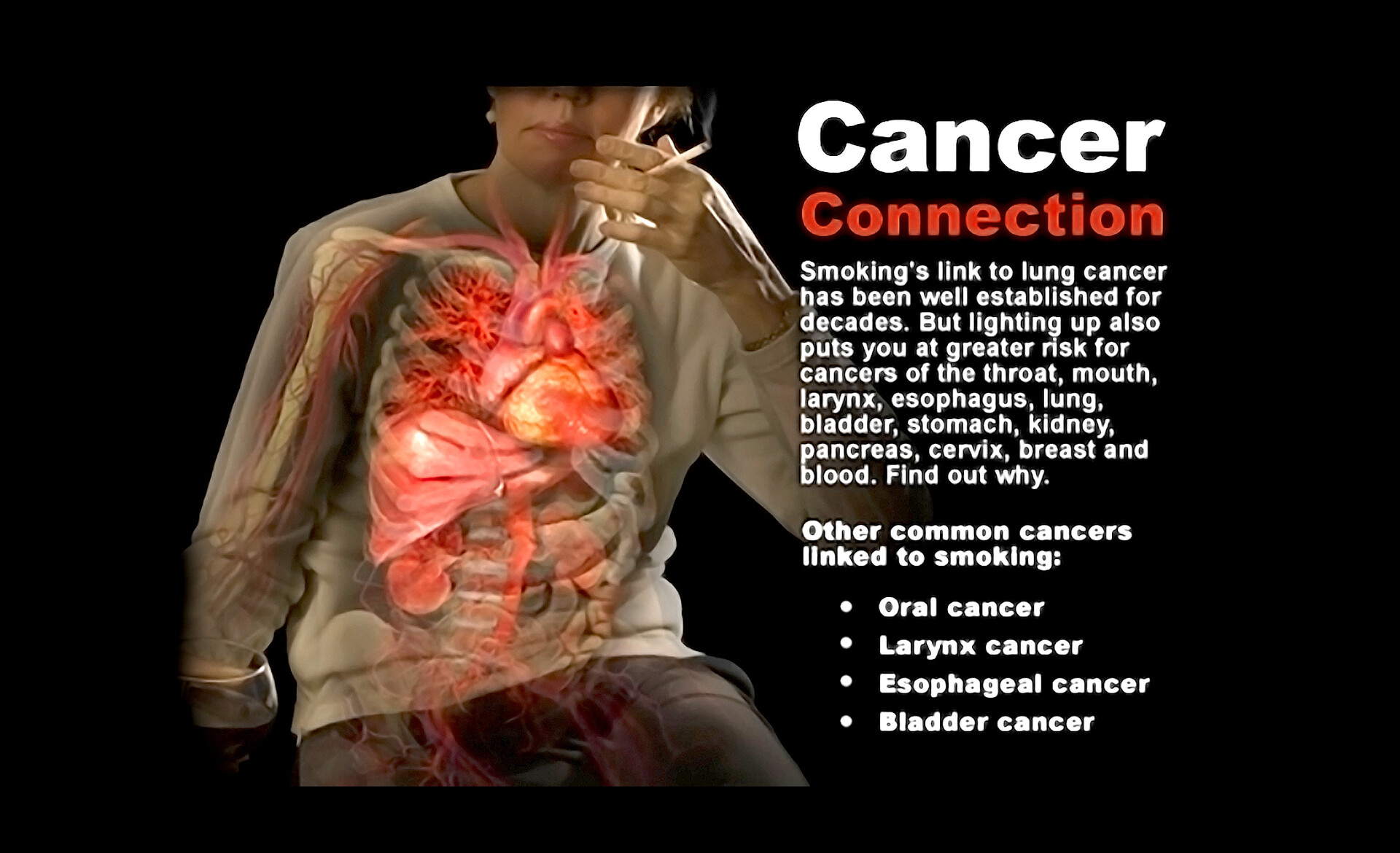 Kidney Cancer From Smoking