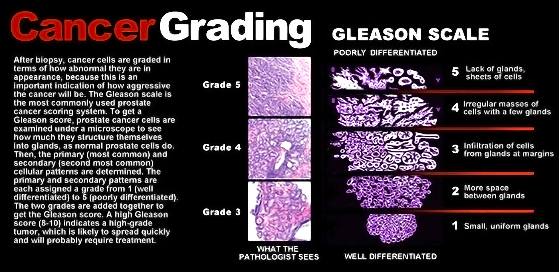 What Are Some of the Cancer TypeSpecific Grading Systems? StoryMD