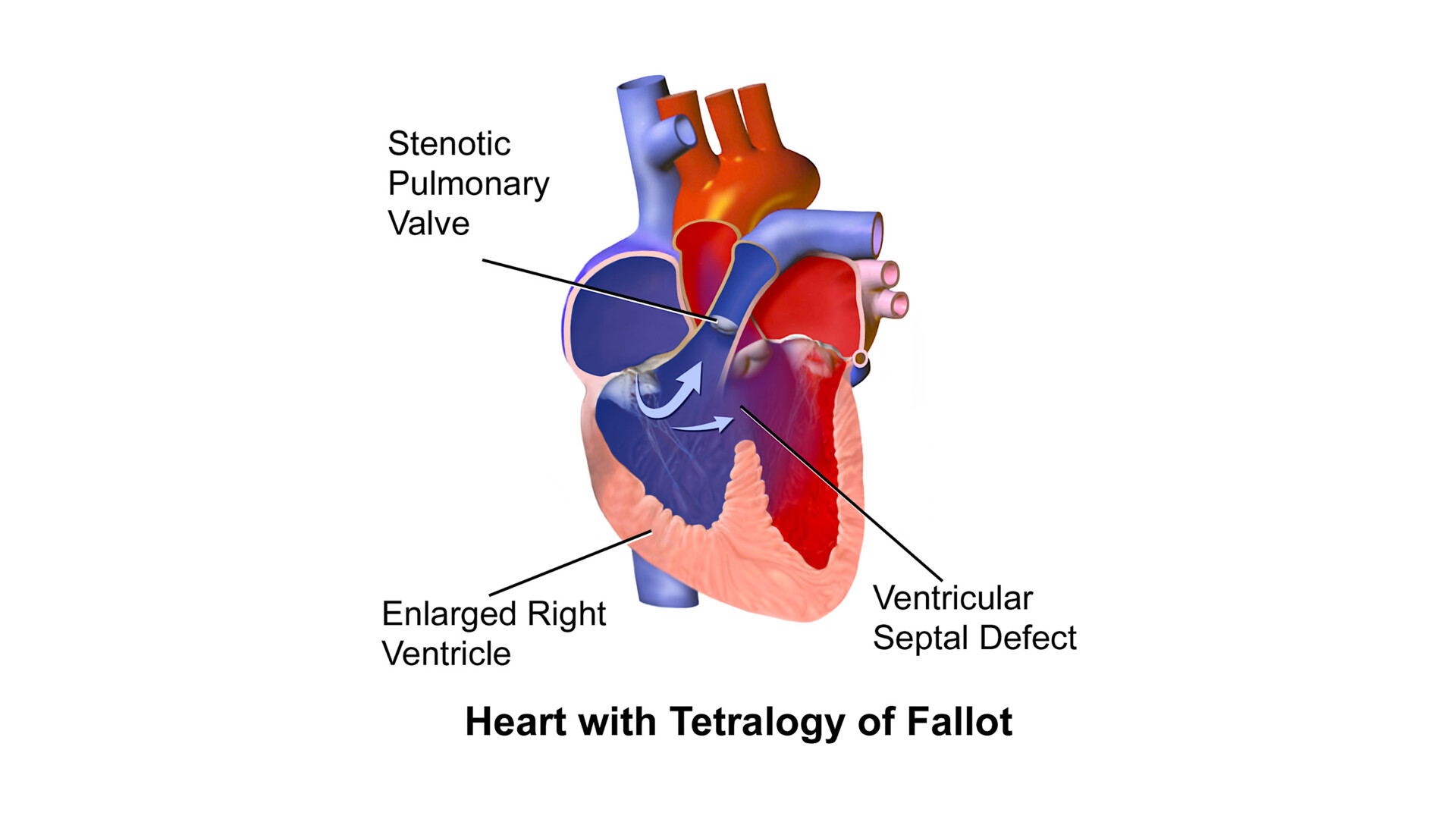 What Is Tetralogy of Fallot? StoryMD