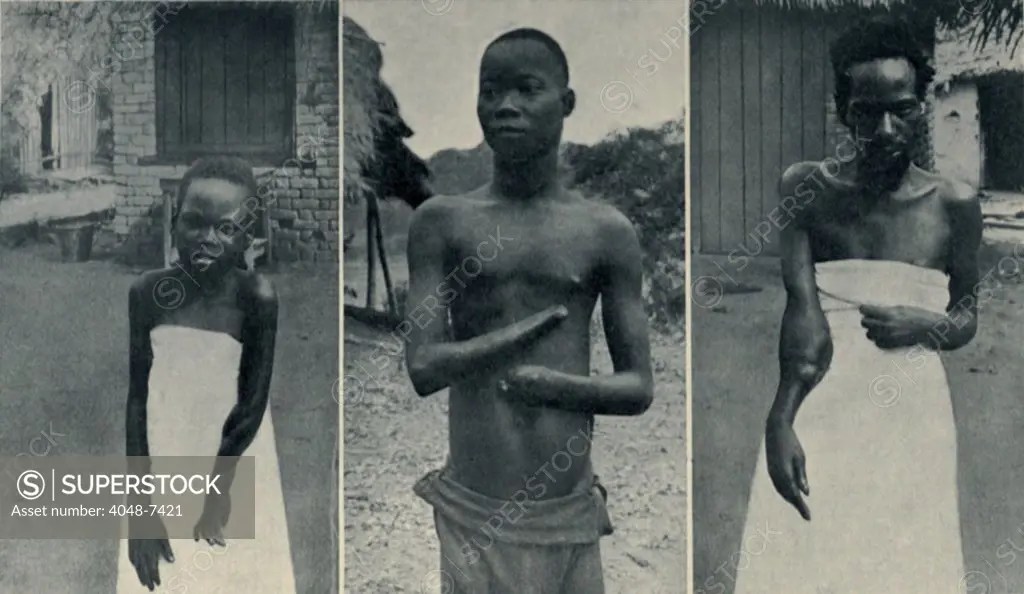 Atrocities of the Rubber Slavery in the Belgian Congo. Mongala (left
