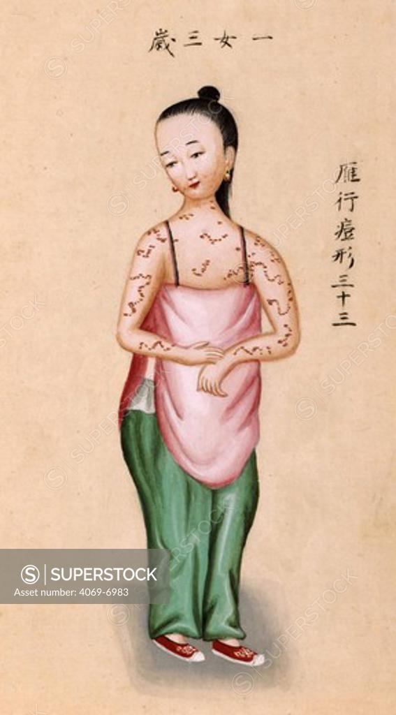 Young Chinese girl with smallpox, illustration from 'Notes on Diverse