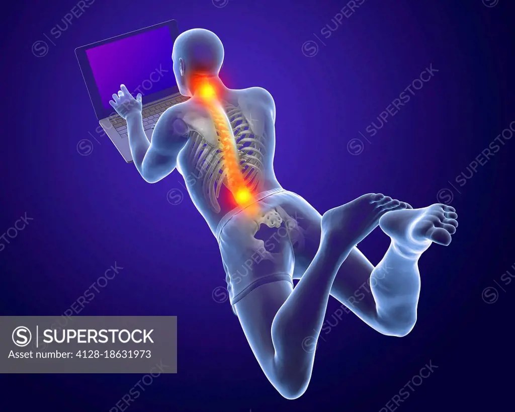 Bad posture whilst using laptop, illustration SuperStock