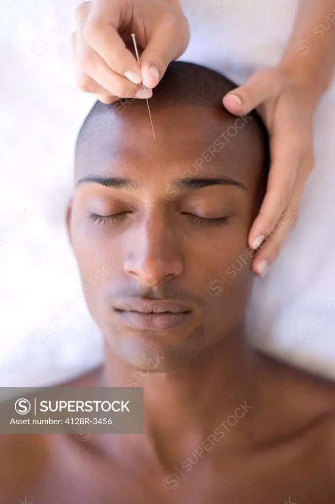 Acupuncture SuperStock