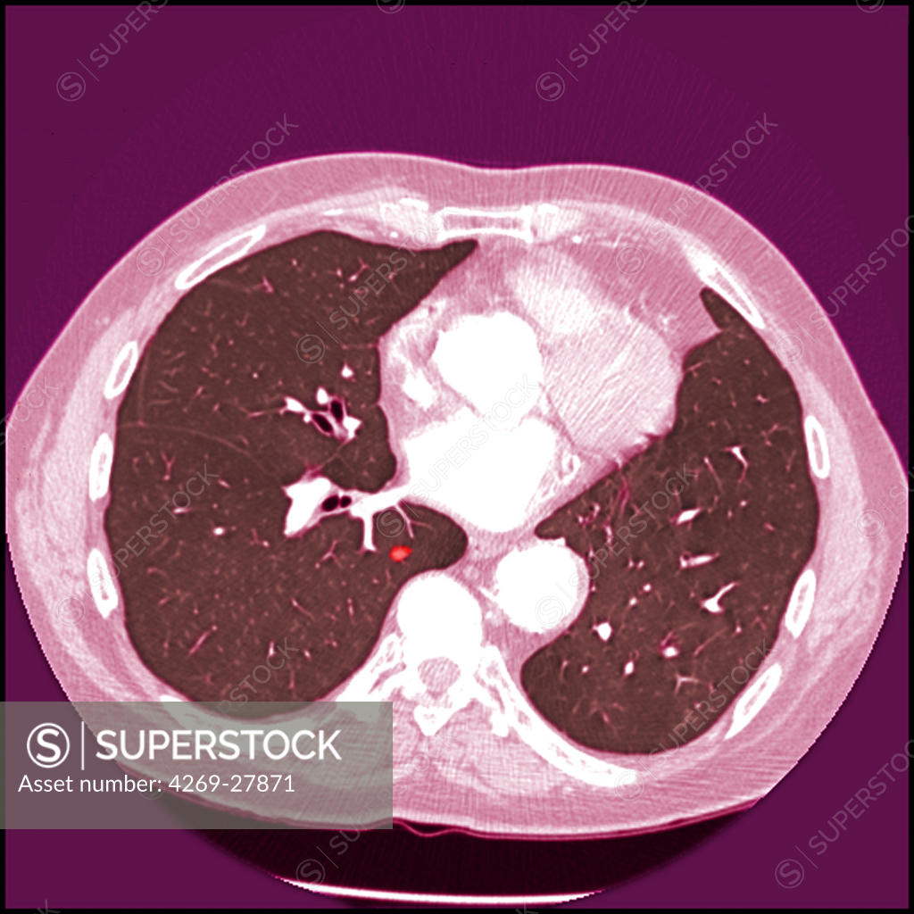 Lung cancer. Colored Computed Tomography (CT) scan of the abdomen showing early stage lung